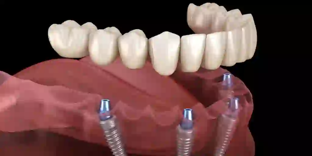 Dental Implants – Procedure and Benefits