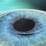 LASIK